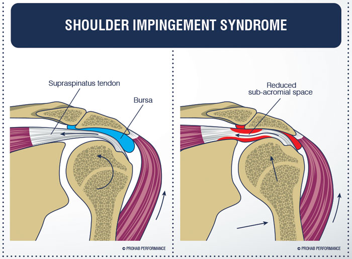 Diagram Of Shoulder Pain - Shoulder Pain Could It Be Your Rotator Cuff