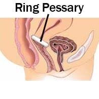Support Pessaries for pelvic organ prolapse