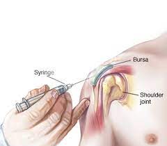 Physiotherapy and sub-acromial injections for management of shoulder pain